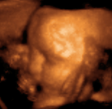 ultrasonografia 3d płodu
